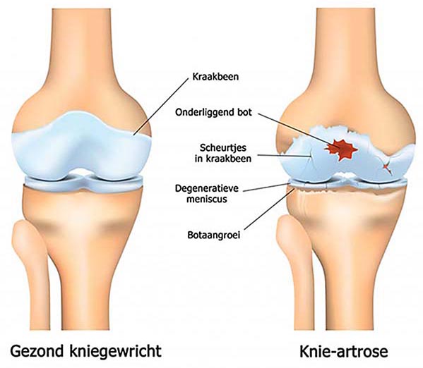 Knie artrose 599x599